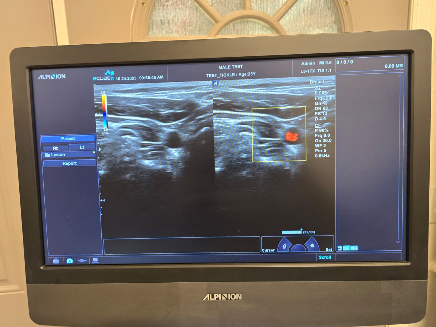 Alpinion E-CUBE 15 Ultrasound System with L8-17X Transd. – 2018