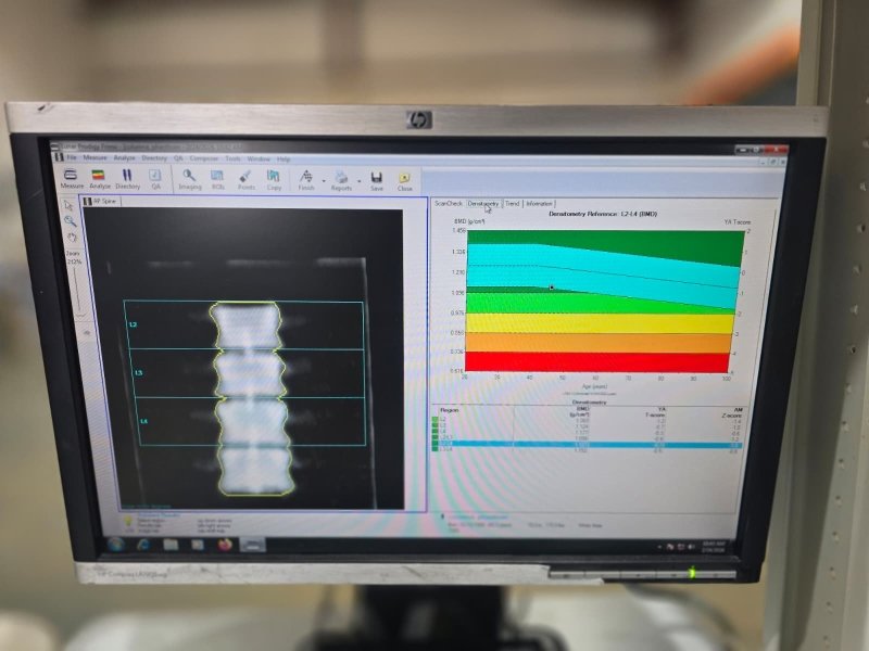 GE Lunar Prodigy Advance DXA Bone Densitometer - inCAV Medical Imaging Equipment