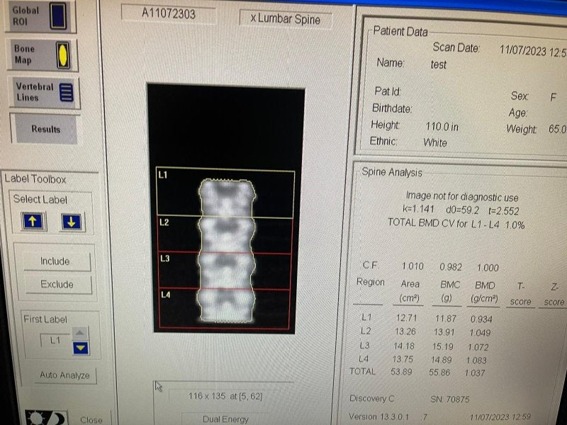 HOLOGIC Discovery QDR series 2012 DEXA Bone Densitometer - inCAV Medical Imaging Equipment